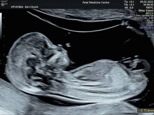 Nuchal Scan